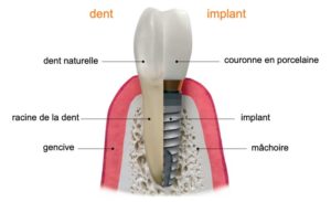 dents-naturelles-vs-implants