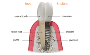 natural teeth vs implants