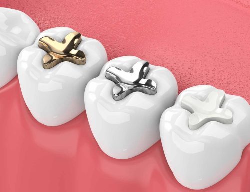 Dental fillings: your top 14 questions answered