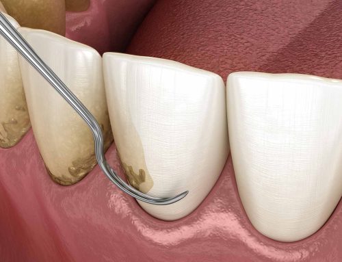 Tartre dentaire vs plaque dentaire: Quelle est la différence?