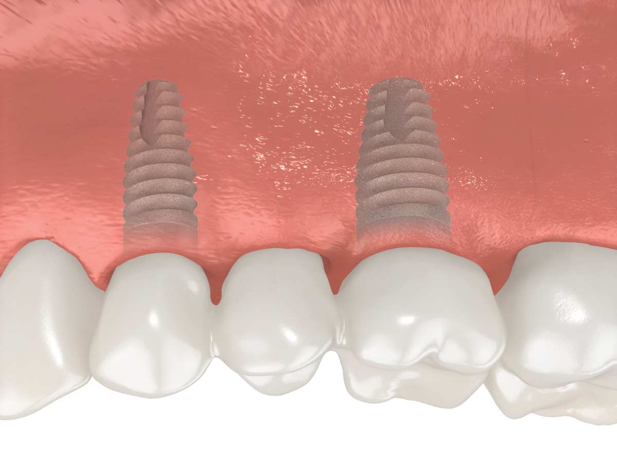 couronnes sur implants