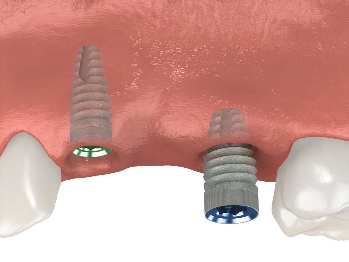 insertion des implants dentaires