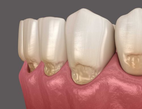 Receded gums and loose teeth: is a gum graft the only solution?