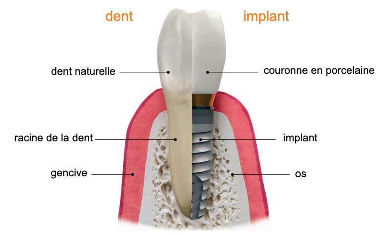 dent naturelle vs implant